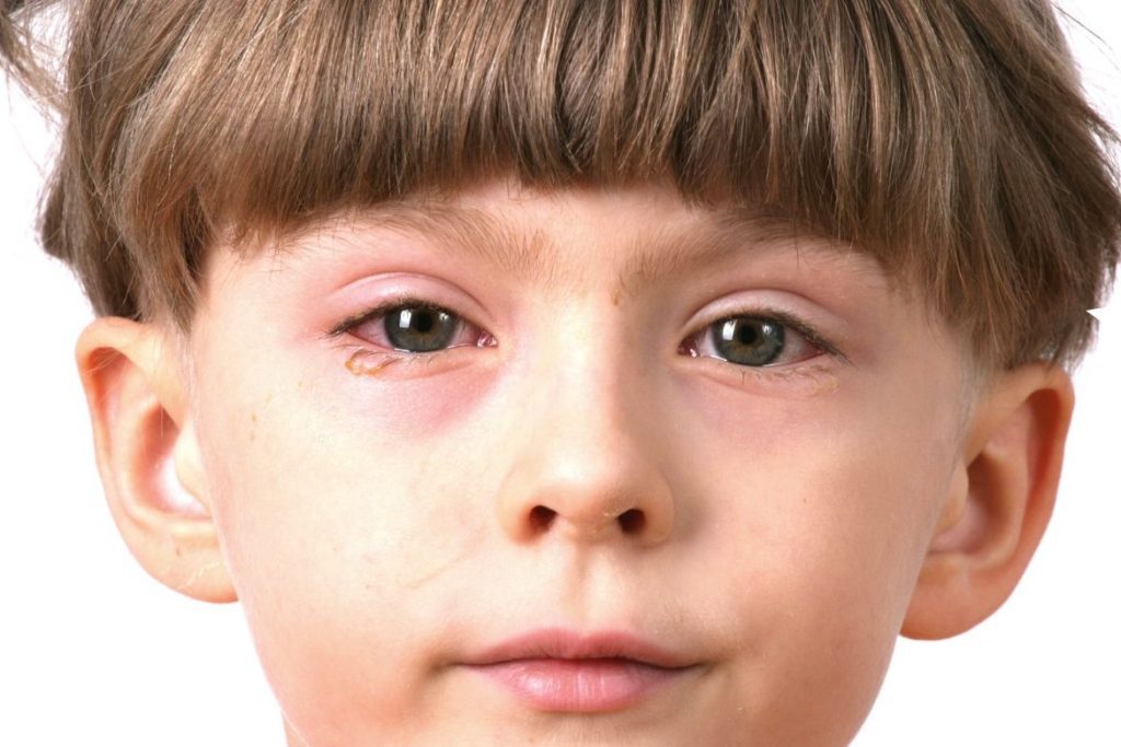 Natural Treatments for Conjunctivitis