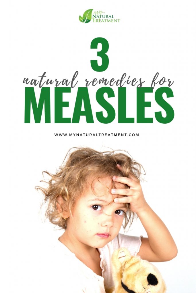 Natural Remedies for Measles