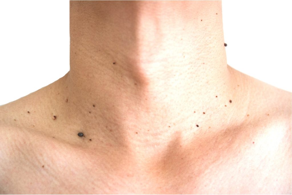 Natural Remedies for Skin Moles & Skin Tags