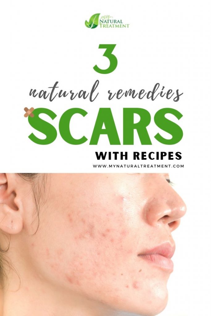 Natural Remedies for Scars with Recipes #scarremedy#scartreatment