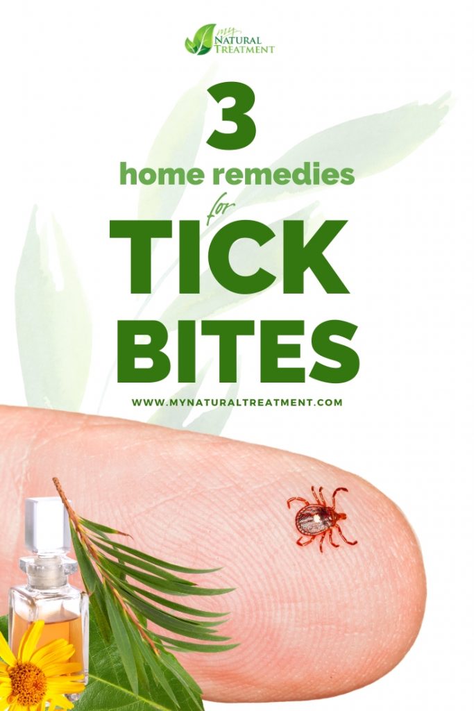 3 Home Remedies for Tick Bites