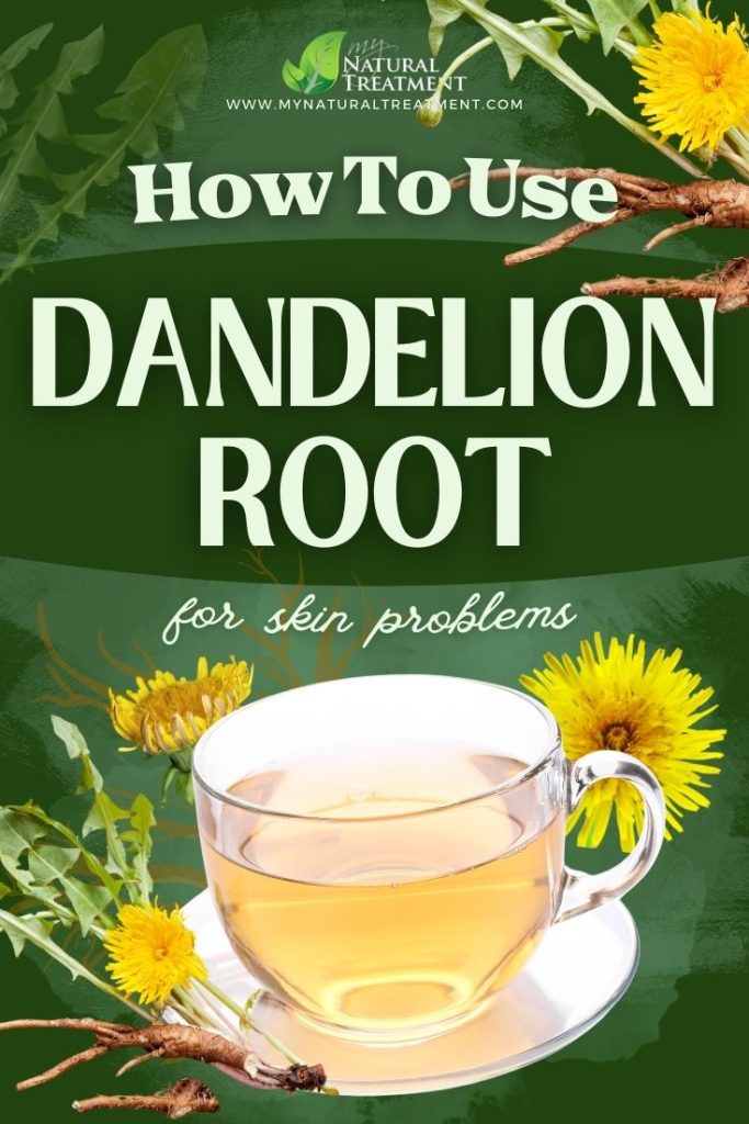 How to Use Dandelion Root for Skin Problems 5 How to Use Dandelion Root for Skin Problems - MyNaturalTreatment.com