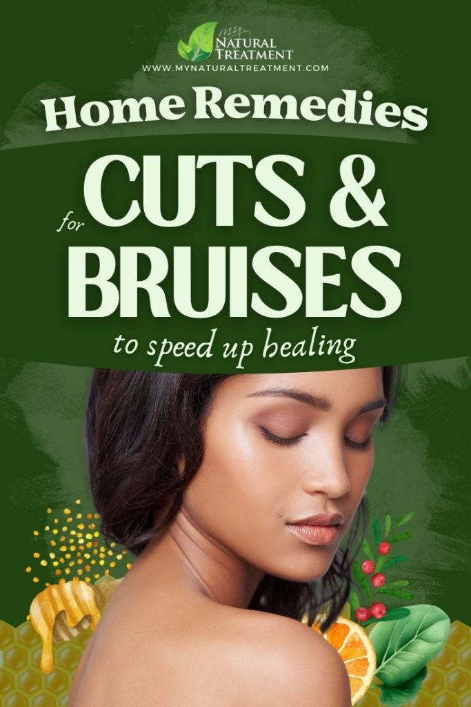 9 Home Remedies to Speed Up Healing for Cuts and Bruises 8 9 Home Remedies to Speed Up Healing for Cuts and Bruises - MyNaturalTreatment.com