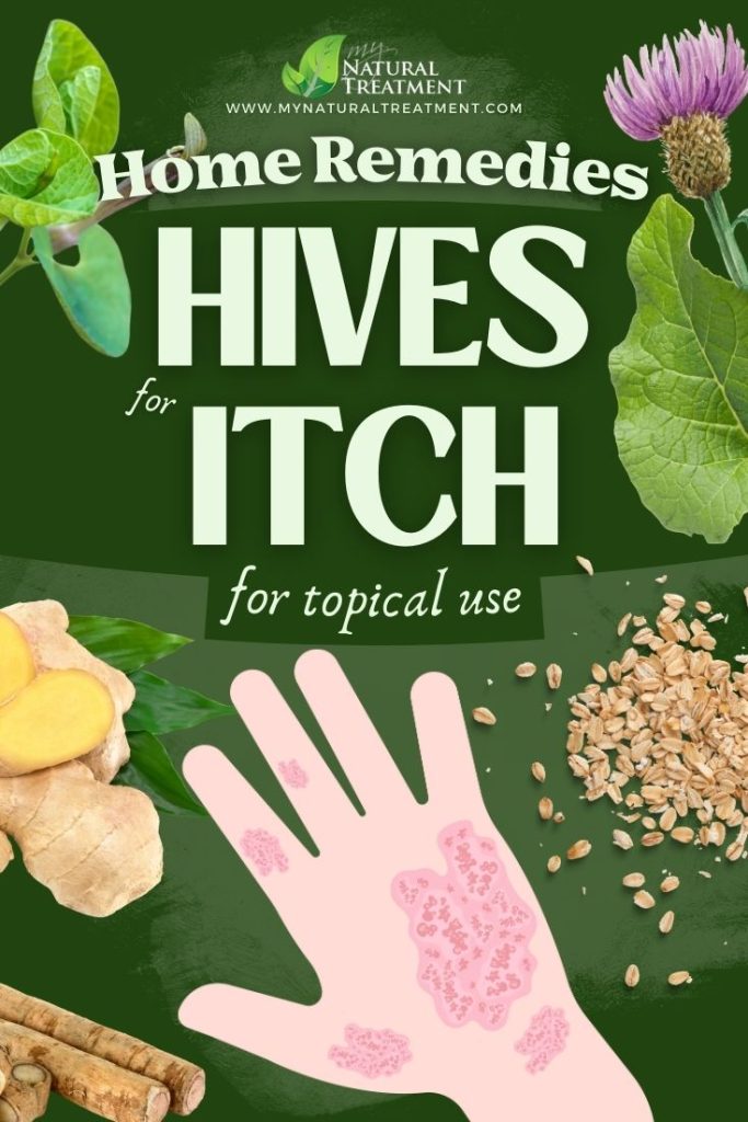 9 Topical Home Remedies for Hives Itch 4 9 Topical Home Remedies for Hives Itch - MyNaturalTreatment.com