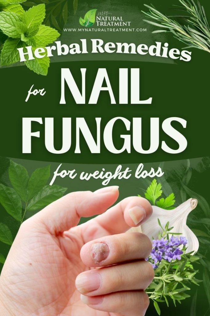 5 Powerful Herbal Remedies for Nail Fungus 13 5 Powerful Herbal Remedies for Nail Fungus - MyNaturalTreatment.com