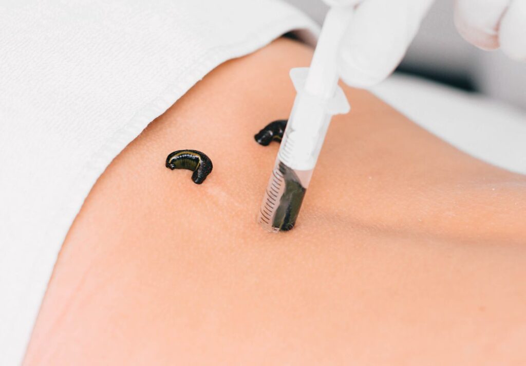 5 Amazing Health Benefits of Leech Therapy - Hirudotherapy Explained 3 Amazing Health Benefits of Leech Therapy - Hirudotherapy Explained - MyNaturalTreatment