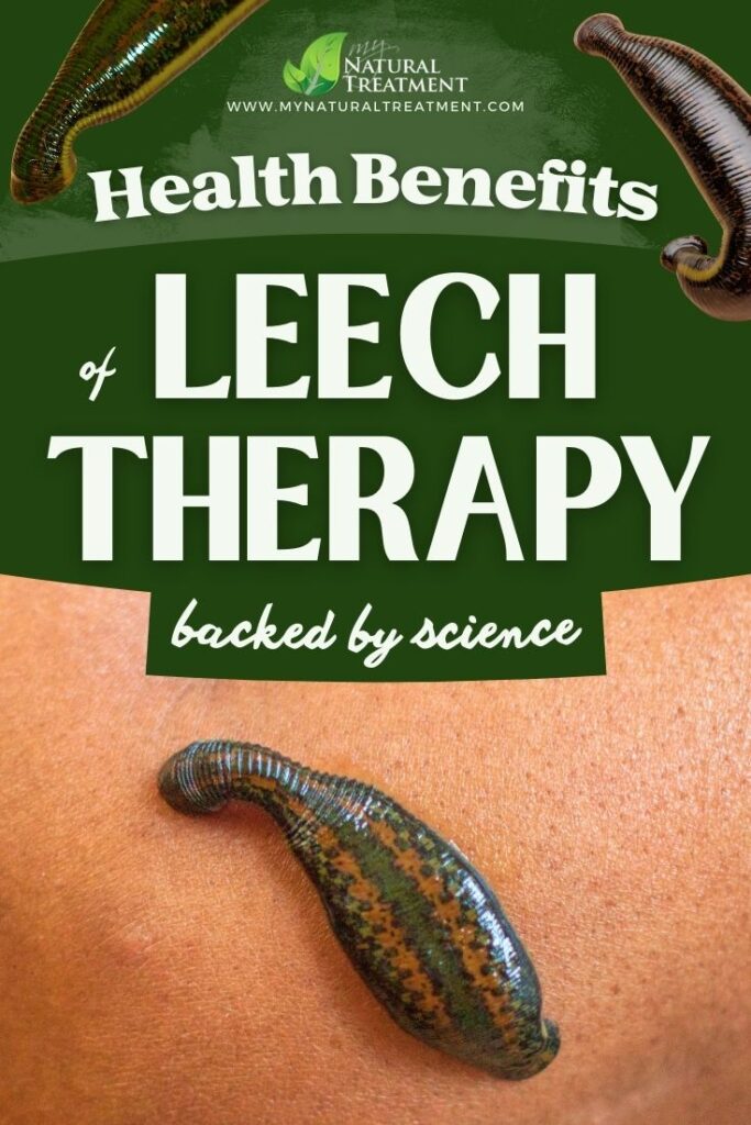 5 Amazing Health Benefits of Leech Therapy - Hirudotherapy Explained 6 Amazing Health Benefits of Leech Therapy - Hirudotherapy Explained - MyNaturalTreatment