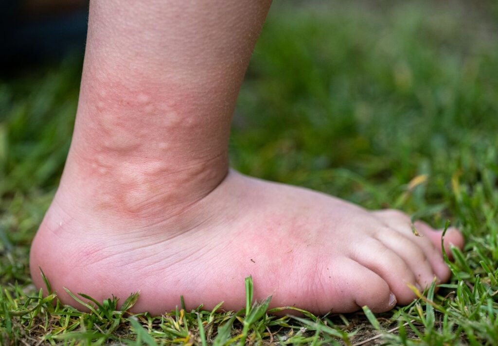 Is The Sting from Stinging Nettle Good for You? 4 Is The Sting from Stinging Nettle Good for You? - MyNaturalTreatment