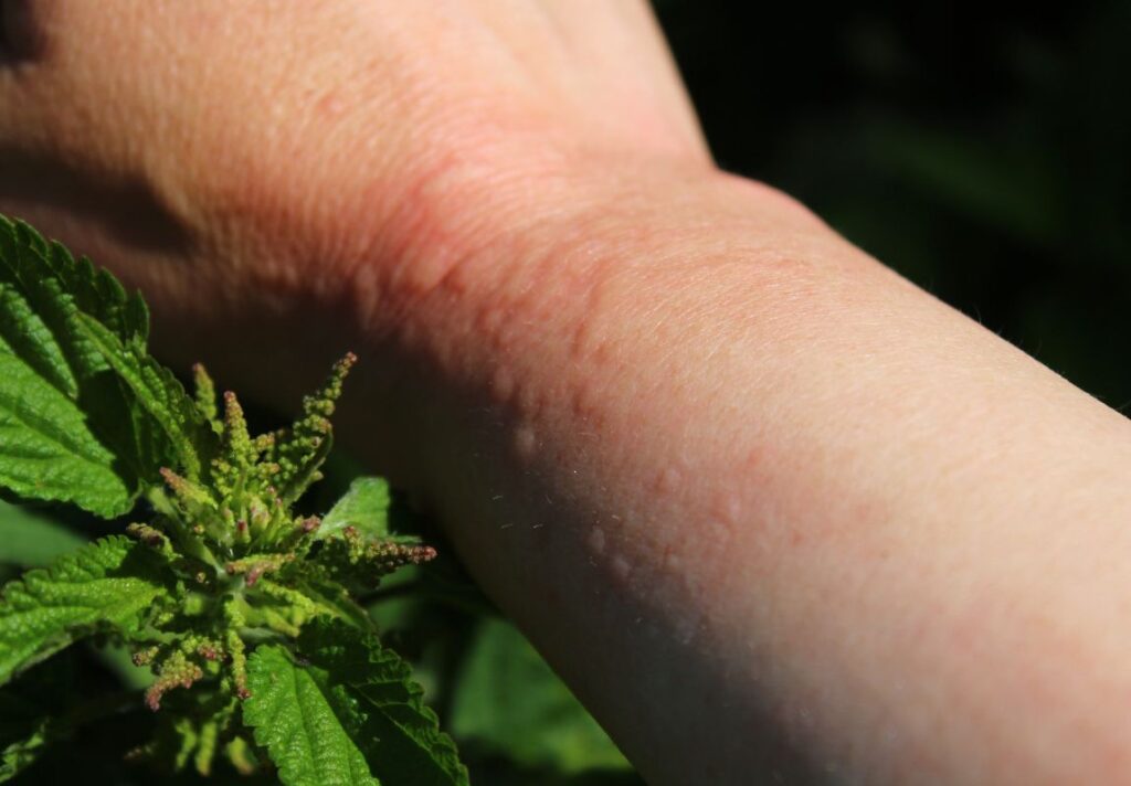 Is The Sting from Stinging Nettle Good for You? 3 Is The Sting from Stinging Nettle Good for You? - MyNaturalTreatment