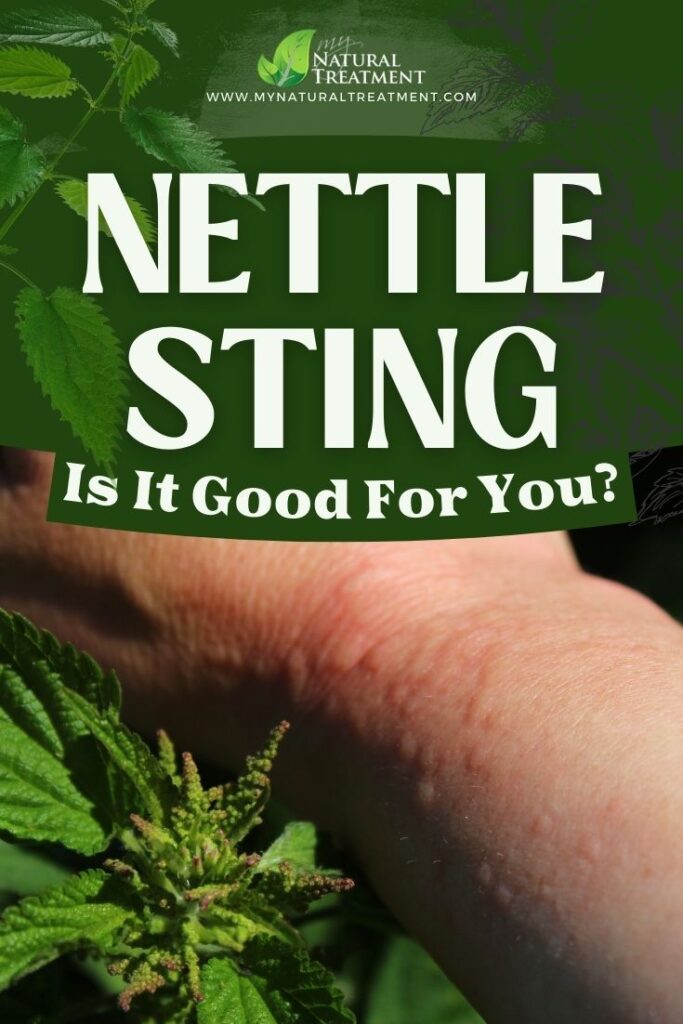 Is The Sting from Stinging Nettle Good for You? 5 Is The Sting from Stinging Nettle Good for You? - MyNaturalTreatment